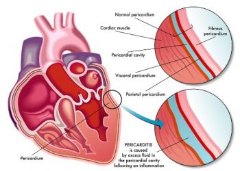 Pericarditis Symptoms