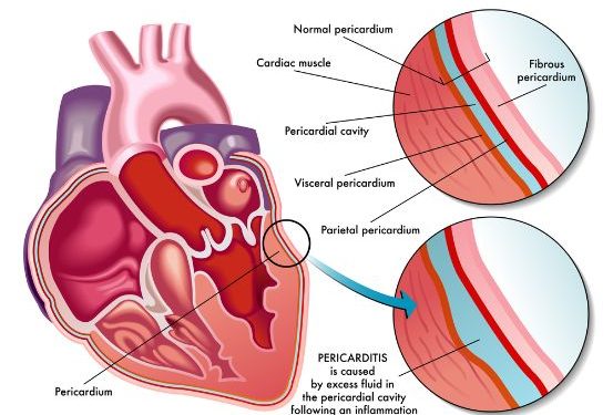 Pericarditis Symptoms