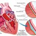 Pericarditis Symptoms