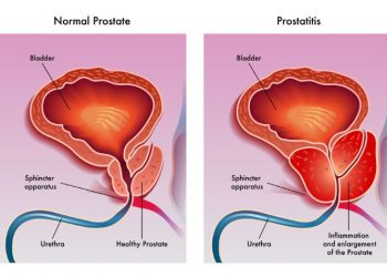 Prostatitis Nonbacterial Chronic Symptoms