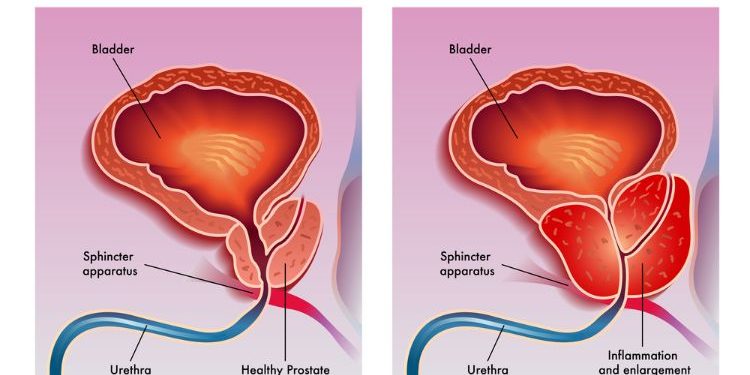 Prostatitis Nonbacterial Chronic Symptoms