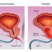 Prostatitis Nonbacterial Chronic Symptoms