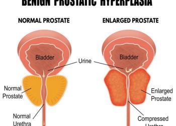 Lower Urinary Tract Symptoms of Benign Prostate Enlargement