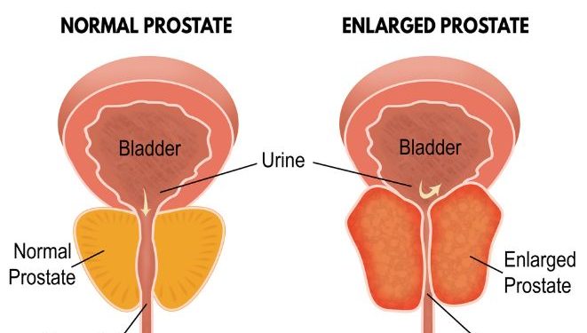 Lower Urinary Tract Symptoms of Benign Prostate Enlargement