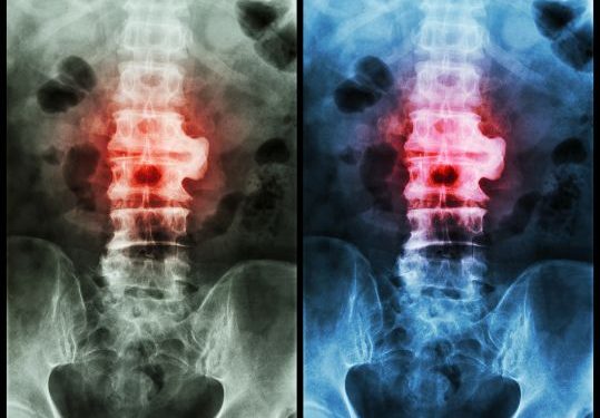 How to Manage Ankylosing Spondylitis Symptoms