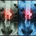 How to Manage Ankylosing Spondylitis Symptoms