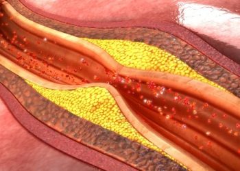 Atherosclerosis
