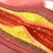 Atherosclerosis