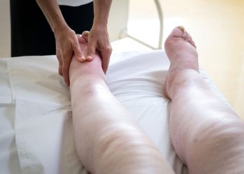 Leg Edema Symptoms and Treatment