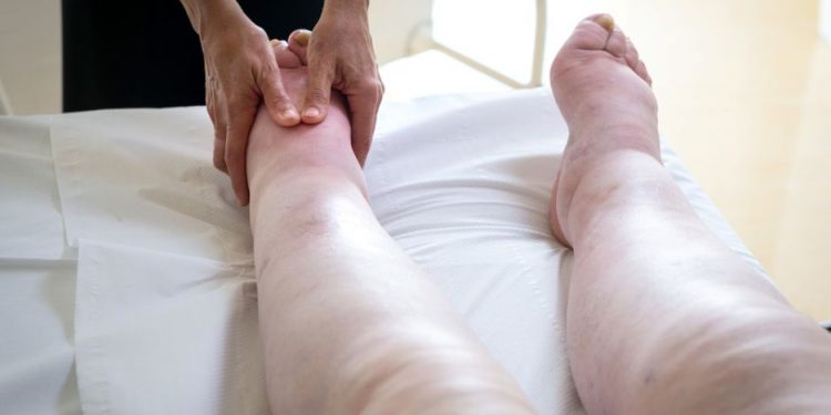 Leg Edema Symptoms and Treatment