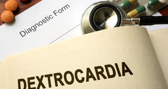 Dextrocardia Symptoms