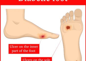 Diabetic Foot