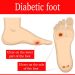 Diabetic Foot
