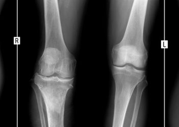 Osteomyelitis Symptoms