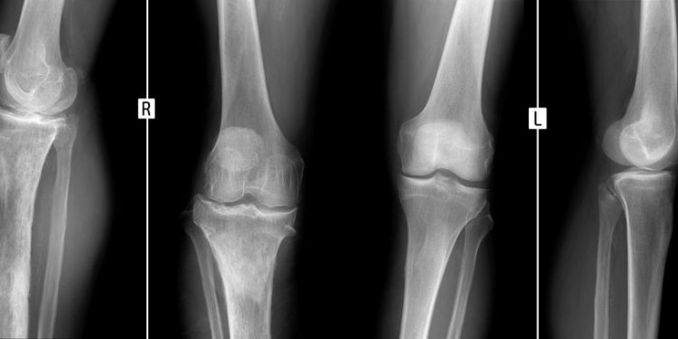 Osteomyelitis Symptoms