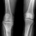Osteomyelitis Symptoms