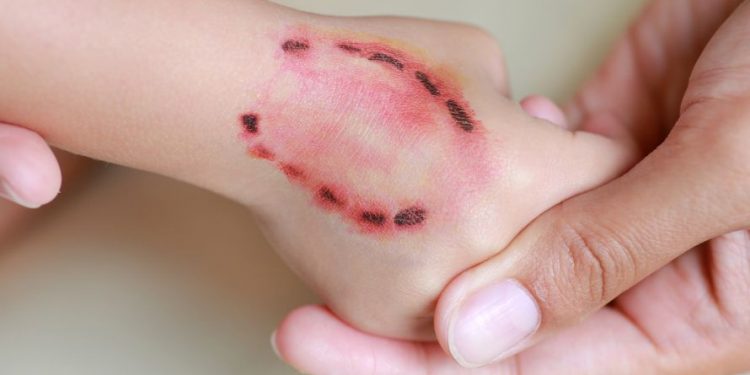 Rabies Symptoms