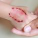 Rabies Symptoms