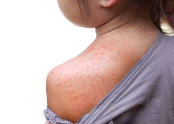 What Are the Symptoms of Measles?
