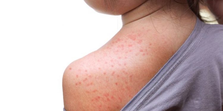 What Are the Symptoms of Measles?