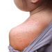 What Are the Symptoms of Measles?