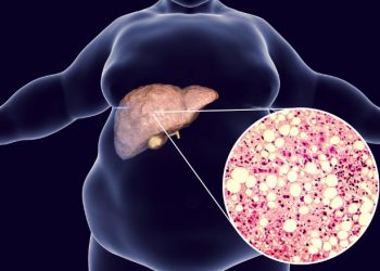 Fatty Liver Symptoms