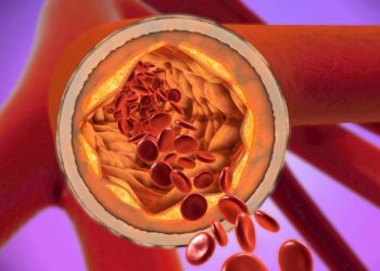 Arterial Occlusion Symptoms
