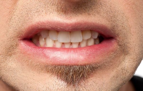 Teeth Grinding Symptoms