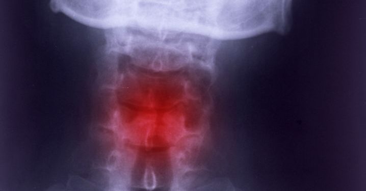 Larynx Trauma