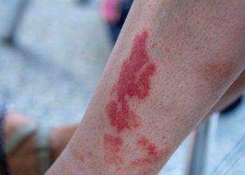 Vasculitis Symptoms and Causes