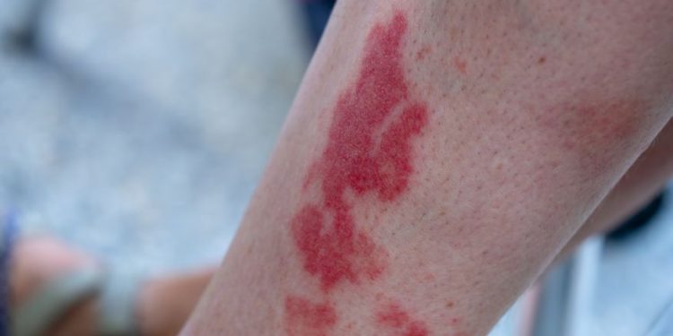 Vasculitis Symptoms and Causes