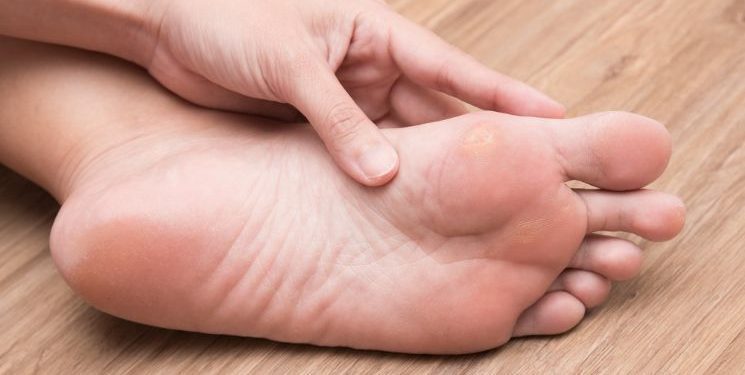 How to Prevent Calluses and Corns Symptoms