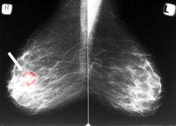 Inflammatory Breast Cancer