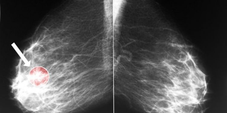 Inflammatory Breast Cancer