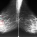 Inflammatory Breast Cancer