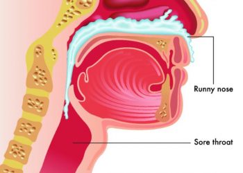 Upper Respiratory Tract Infection