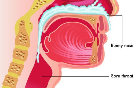 Upper Respiratory Tract Infection