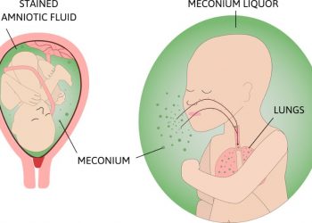 Meconium Ileus in Babies