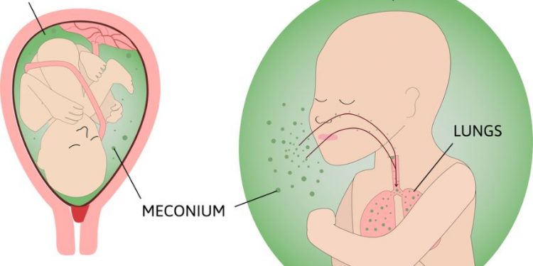 Meconium Ileus in Babies