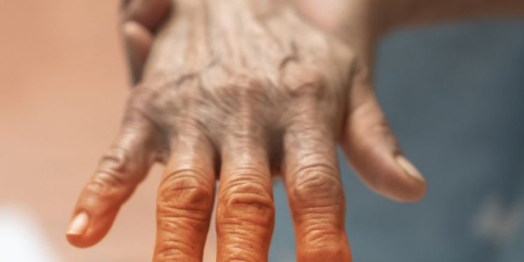 What Are the Symptoms of Burn Infections?