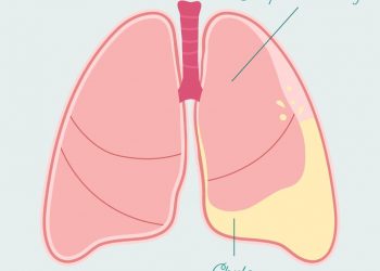 Chylothorax Symptoms