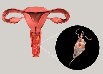 Trichomoniasis Symptoms