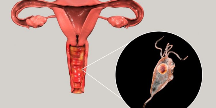 Trichomoniasis Symptoms