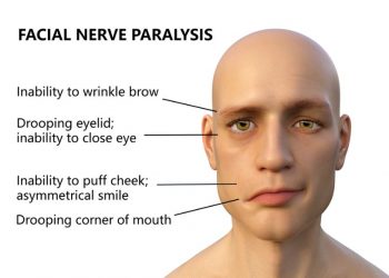 Facialis Symptoms