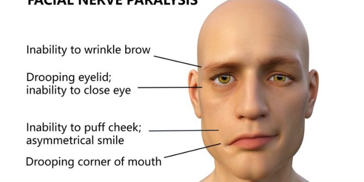 Facialis Symptoms