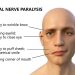 Facialis Symptoms