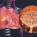 Are Lung Fungi Workers Exposed to Climate Change?