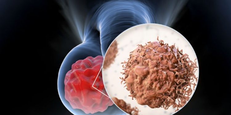 Testicular Pain Symptoms