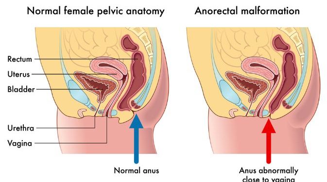 Anorectal Function of Pain Symptoms