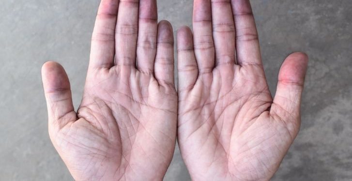 Cyanosis Symptoms and Causes